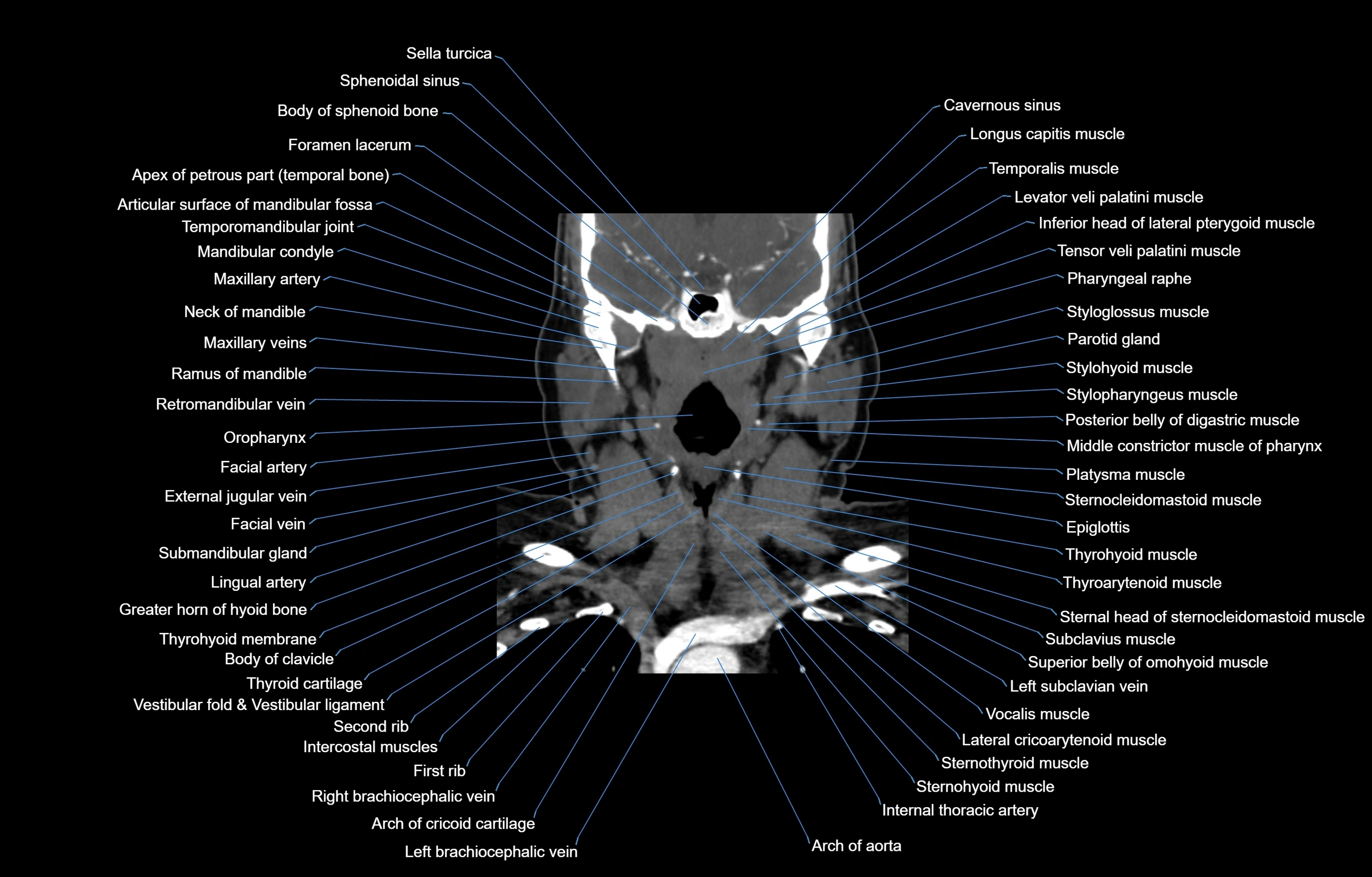 CT Neck coronal  cross sectional anatomy labelled 3D  radiology  image-00032.webp